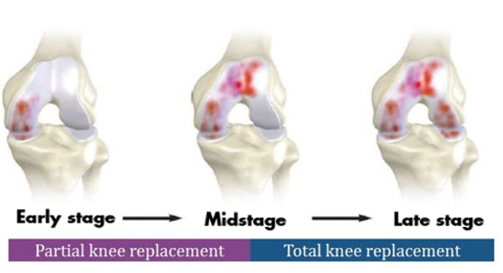 Knee Replacement