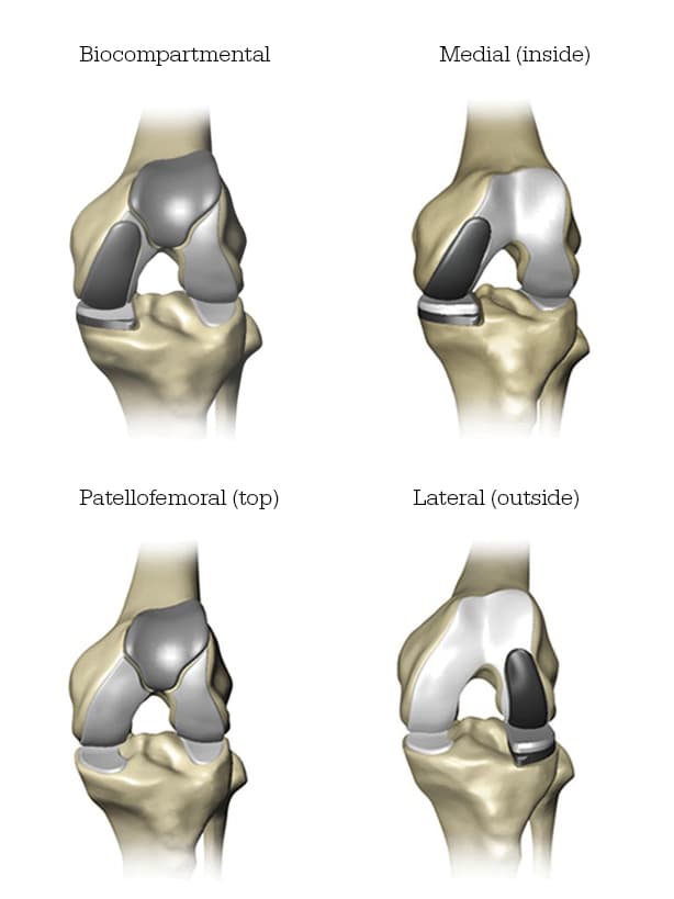 Knee Replacement Types