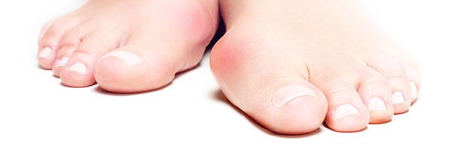 Bunion needing lapiplasty
