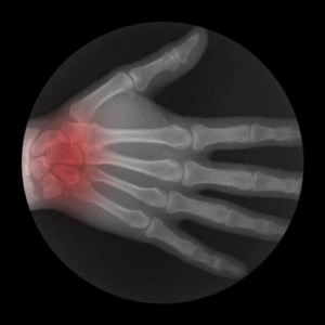 Hand Xray Wrist